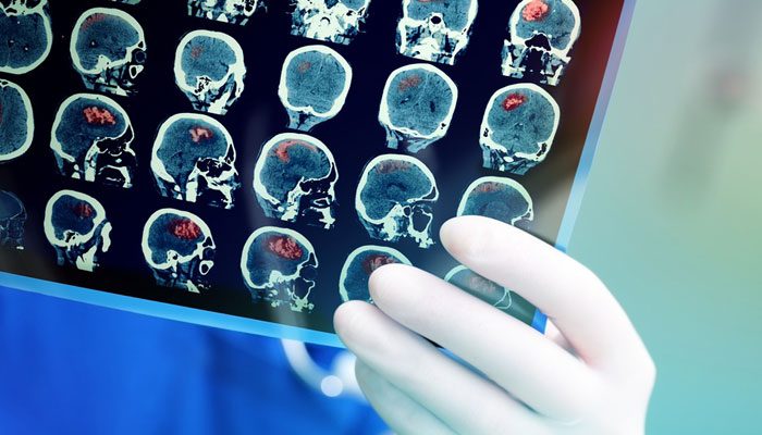 Stroke Scan